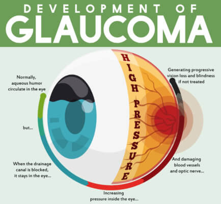 Diagram explaining how glaucoma develops. 