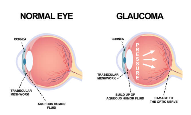 Diagram of eyes with and without glaucoma.