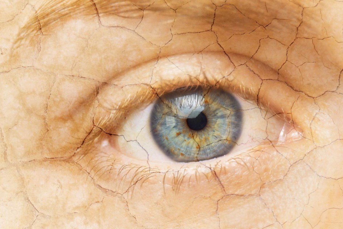 Close-up of an eye with cracked, dry skin texture overlay, representing dry eyes and discomfort.