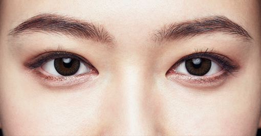 1 Day Acuvue Define Radiant Charm lenses are worn, showing eye enhancement