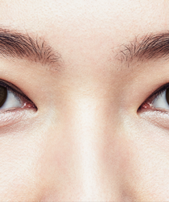 1 Day Acuvue Define Radiant Bright lenses are worn, showing eye enhancement