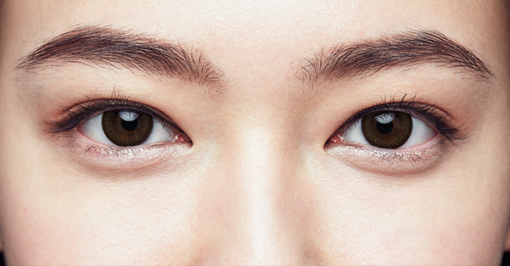 1 Day Acuvue Define Radiant Bright lenses are worn, showing eye enhancement