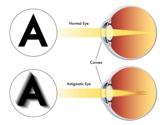 an image of a comparison of normal and astigmatic eyes