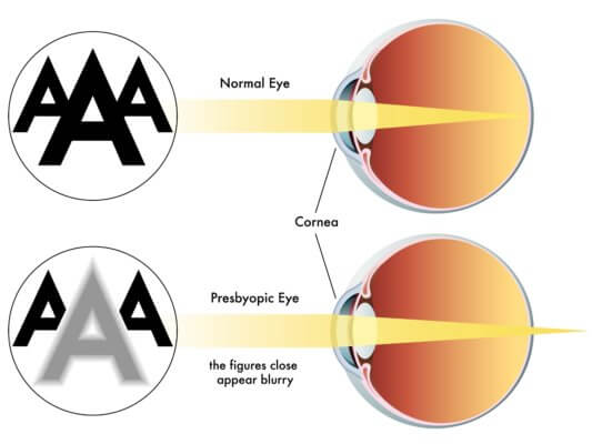 An image of a comparison of normal and presbyopic eyes